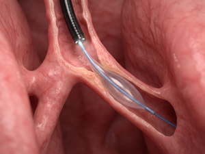 Balon bronkoplasti ile endobronşiyal valfin hava yolu ve akciğer üzerindeki farklı mekanizmalarını gösteren tıbbi illüstrasyon